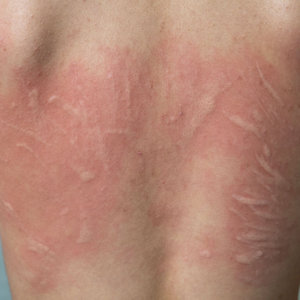 urticaria